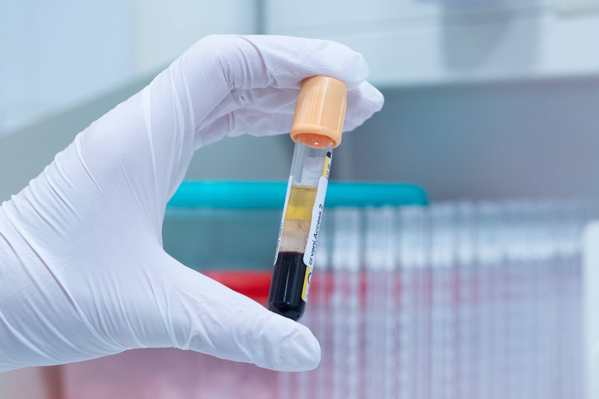 Što znače povišene ili snižene vrijednosti u laboratorijskim nalazima
